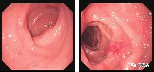 萎縮性胃炎不可怕，只要真正了解它